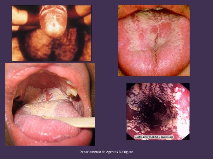 micosis oportunistas